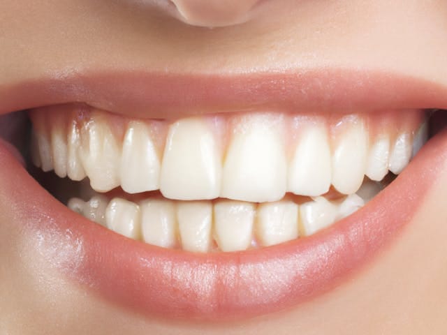 smile restoration