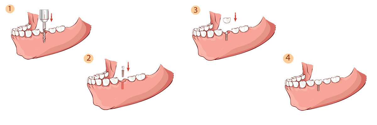 Fullerton Dental Implant Restoration