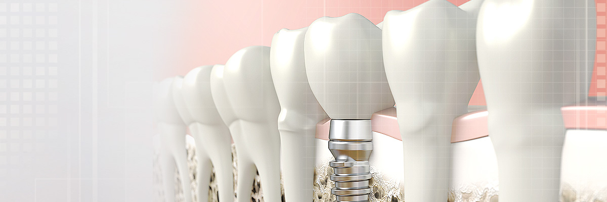 Fullerton Implant Dentist