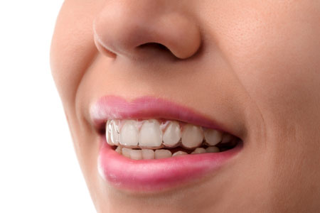 What Happens After My Invisalign® Treatment?