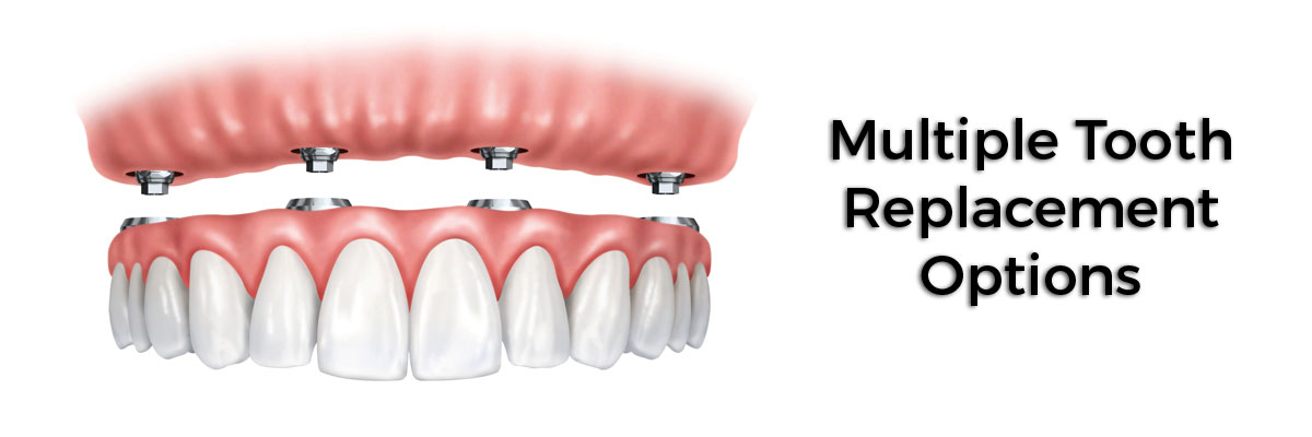 Fullerton Multiple Teeth Replacement Options