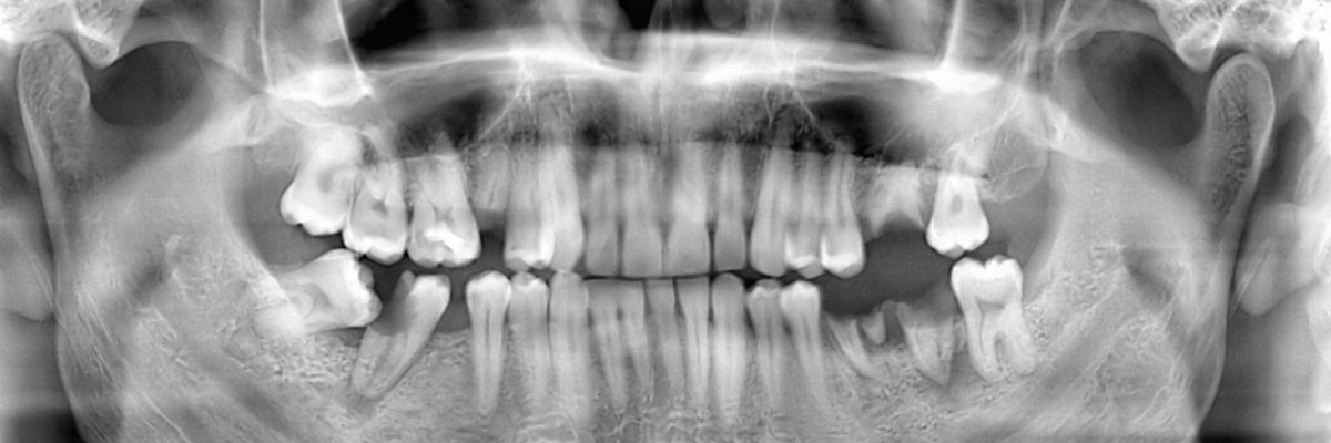 Fullerton Options for Replacing Missing Teeth