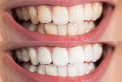 Teeth Whitening near Me  : Boost Your Smile with Professional Teeth Whitening