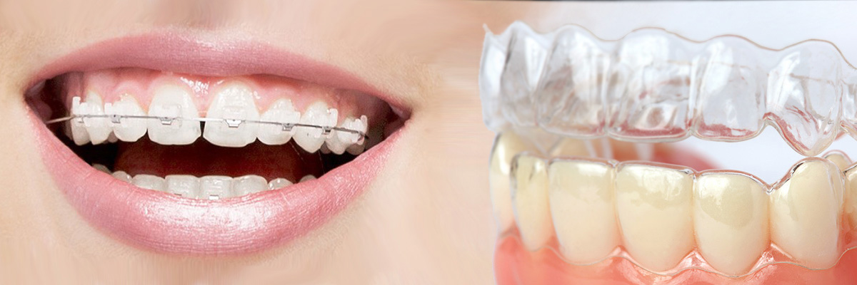 Fullerton Which is Better Invisalign or Braces